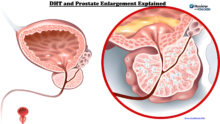 DHT And Prostate Enlargement Explained: Hormonal Role in Prostate Growth