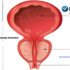What Causes an Enlarged Prostate? Understanding BPH After 40