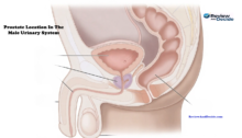What Causes an Enlarged Prostate? Understanding BPH After 40
